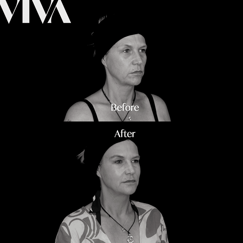 dermal filler