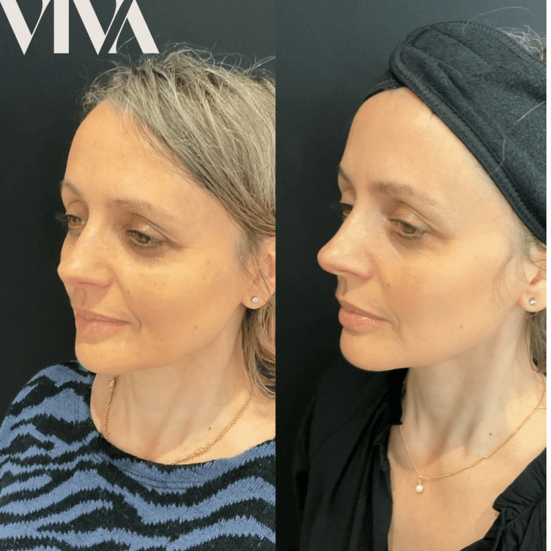 Before & Afters 27 5ml dermal filler before after