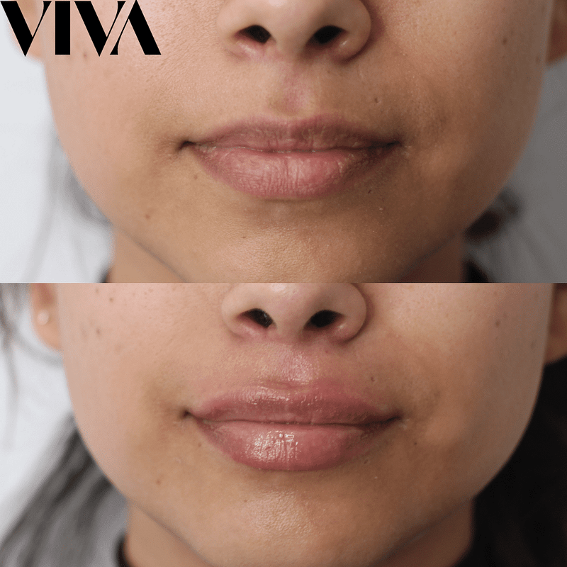 Before & Afters 16 Before and After Lip Fillers