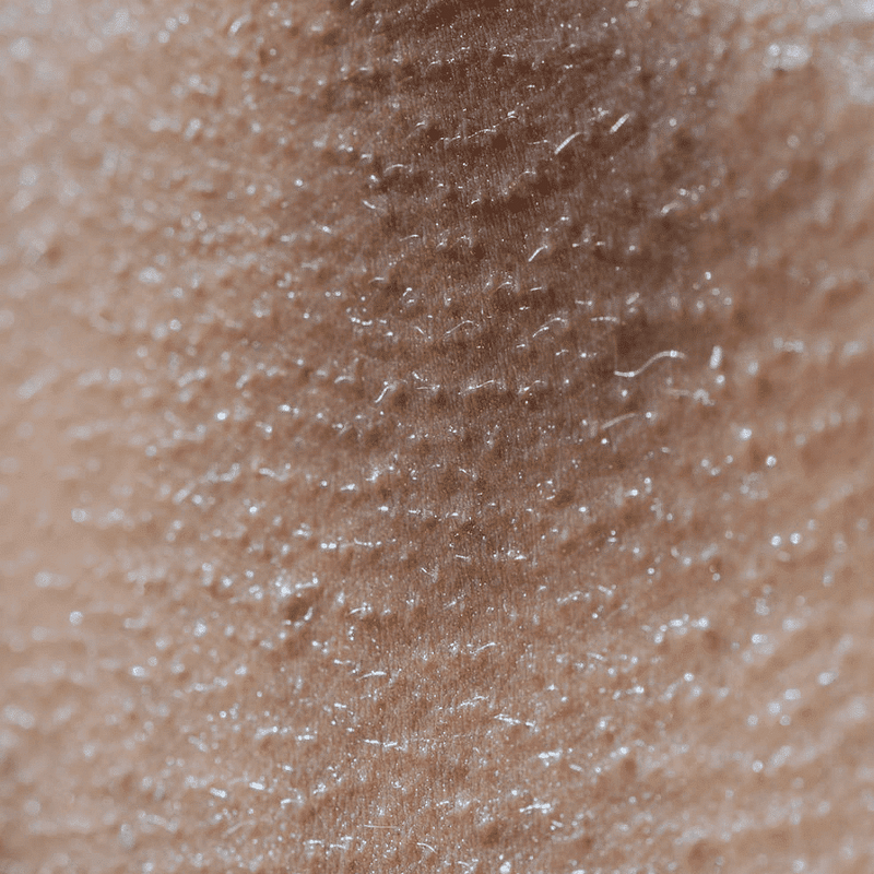 hyperhydrosis