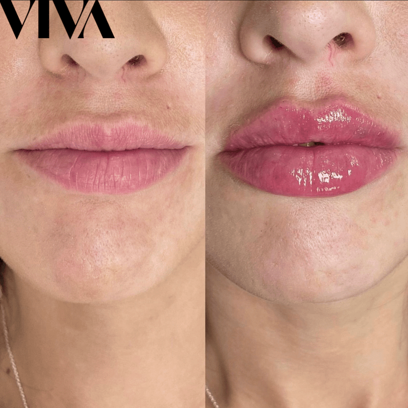 Before & Afters 25 lip filler before after