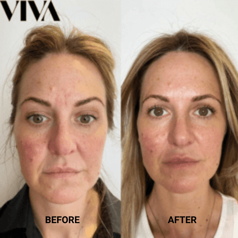 Before & Afters 28 profhilo before after
