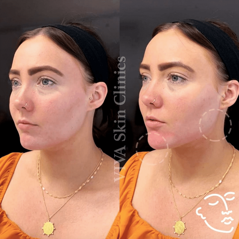 Before and after womens jawline filler