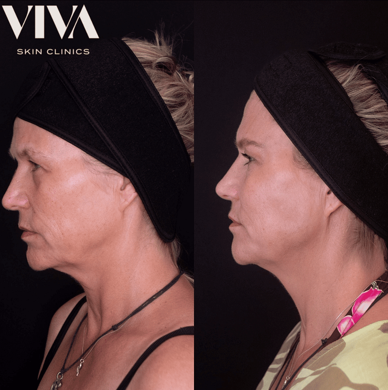 Before & Afters 2 jowl filler before after