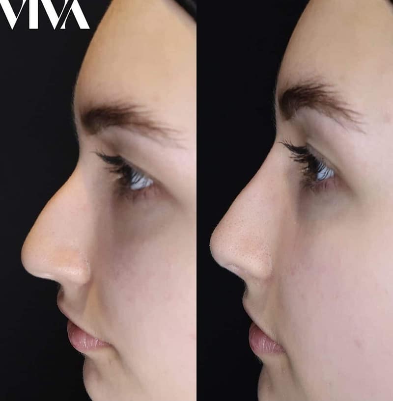 Before & Afters 18 Non Surgical Nose Job