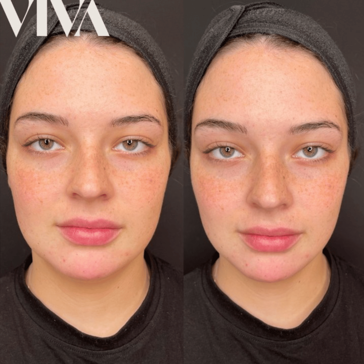 4mls Cheek contour chin 4mls Cheek contour chin